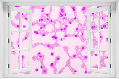 Fototapeta Naklejka Na Ścianę Okno 3D - Picture of acute lymphocytic leukemia or ALL cells in blood smear, analyze by microscope, 400x