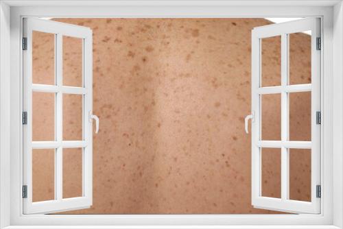 Closeup of man's body with birthmarks as background